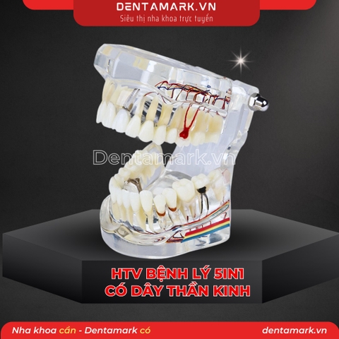 Hàm tư vấn bệnh lý, cầu răng, implant trong nha khoa - Hàm tư vấn 5 in 1 có dây thần kinh