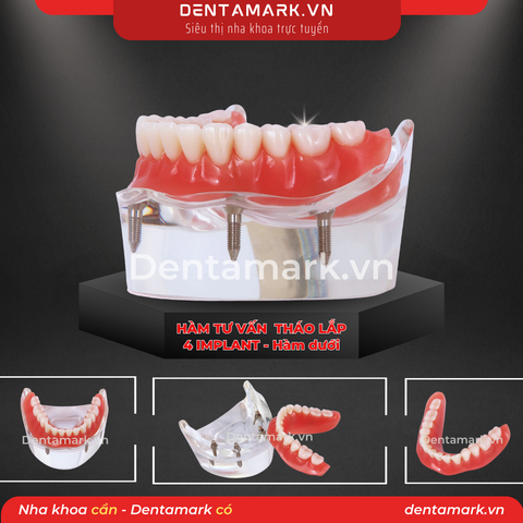Hàm tư vấn tháo lắp 4 Implant - Mẫu hàm tháo lắp trên Implant (Implant All On 4)