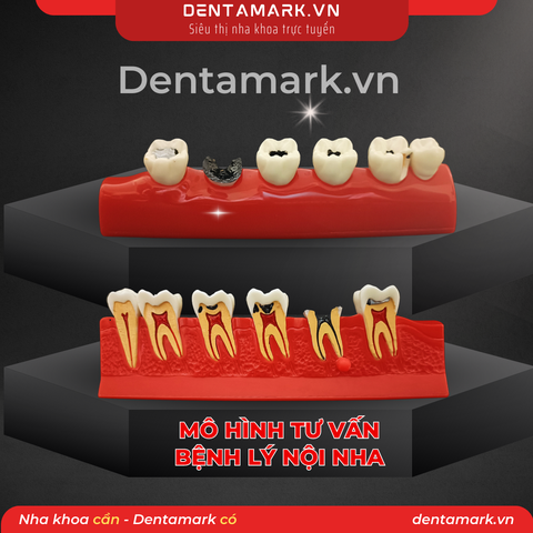 Mô hình tư vấn bệnh lý nội nha - Mô hình giai đoạn sâu răng