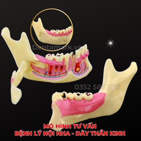 Mô hình giải phẫu tư vấn bệnh lý nội nha - Dây thần kinh
