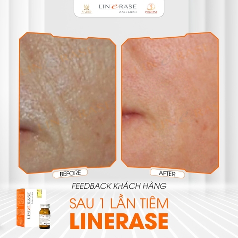 🌟 Linerase Collagen Là Gì? Bí Quyết "Hồi Sinh" Làn Da Chuẩn Y Khoa