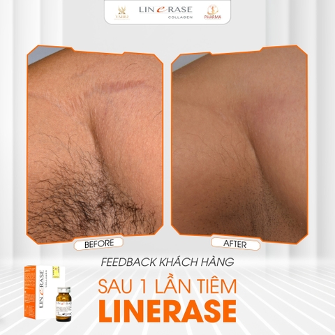 🌟 Linerase Collagen Là Gì? Bí Quyết "Hồi Sinh" Làn Da Chuẩn Y Khoa