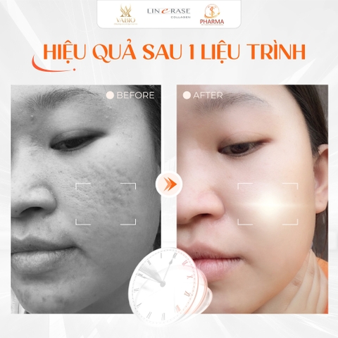 🌟 Linerase Collagen Là Gì? Bí Quyết "Hồi Sinh" Làn Da Chuẩn Y Khoa