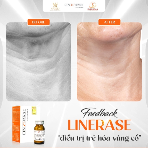 🌟 Linerase Collagen Là Gì? Bí Quyết "Hồi Sinh" Làn Da Chuẩn Y Khoa