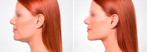 MESOTECH CELLUPHASE / MESO GIẢM NỌNG CẰM, MỠ MÁ VÀ ĐỊNH HÌNH LẠI KHUÔN MẶT