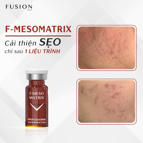 FUSION F-MESOMATRIX / MESO PHƯƠNG PHÁP ĐIỀU TRỊ RỖ