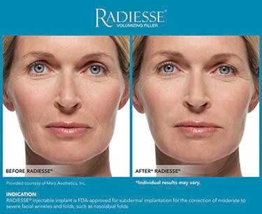 MERZ AESTHETICS RADIESSE / CHẤT LÀM ĐẦY