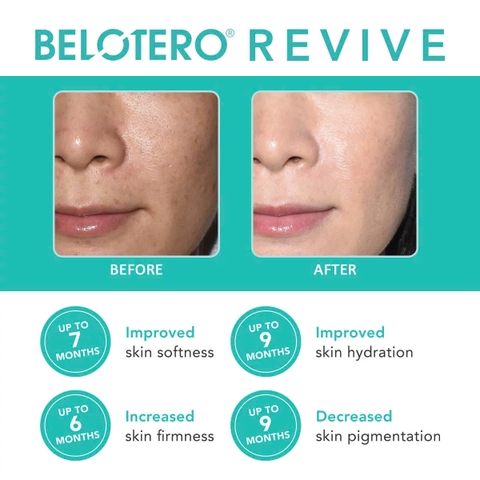BELOTERO REVIVE / CHẤT LÀM ĐẦY