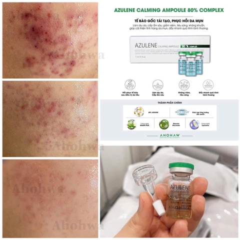 AZULENE CALMING AMPOULE 80% COMPLEX / TẾ BÀO GỐC TÁI TẠO & PHỤC HỒI DA MỤN 