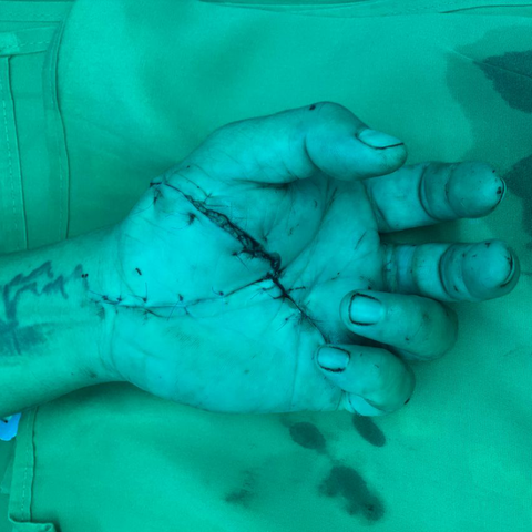 5 giờ xuyên đêm nối bàn tay đứt gần lìa