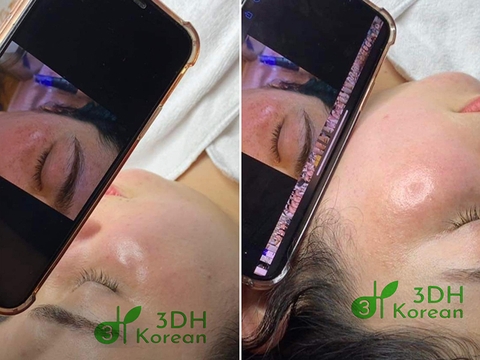 Tổng quan về trị nám