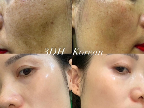 Tăng sắc tố da - Nguyên nhân, triệu trứng và phương pháp điều trị