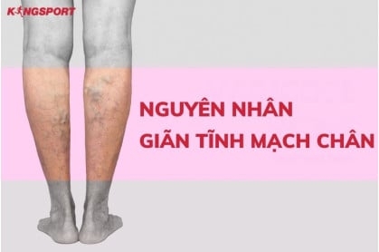NGUYÊN NHÂN GIÃN TĨNH MẠCH CHÂN VÀ CÁCH PHÒNG NGỪA HIỆU QUẢ