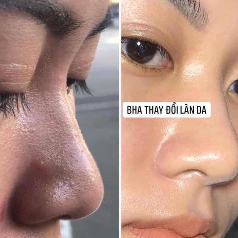 Nước Hoa Hồng Obagi BHA 2% Giảm Nhờn Mụn 148ml Clenziderm MD Pore Therapy Salicylic Acid 2% Acne Treatment