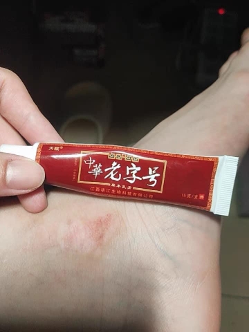 Thuốc bôi Viêm da, á sừng, vẩy nến, lang ben đông y Trung Quốc tuyps 15gr