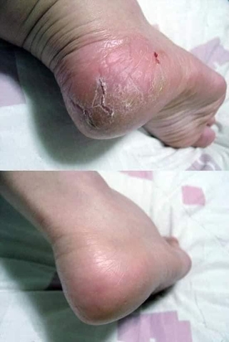 Kem trị nứt gót chân Hellspa Thái Lan