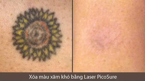 XÓA XĂM AN TOÀN BẰNG LASER CAM KẾT KHÔNG ĐỂ LẠI SẸO - CHĂM SÓC DA SAU KHI LASER