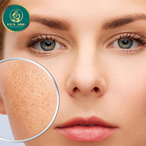 KHÓA ĐÀO TẠO ĐIỀU TRỊ SẸO RỖ