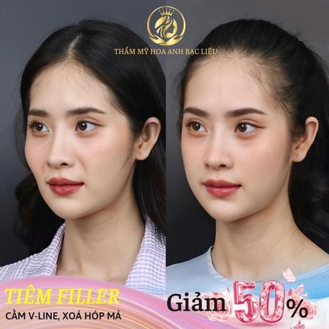 TIÊM FILLER MÁ BABY LÀ GÌ ? GIỮ ĐƯỢC BAO LÂU ? CÓ ẢNH HƯỞNG GÌ KHÔNG ?