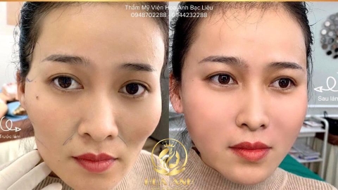 TIÊM FILLER MÁ BAYBY LÀ GÌ ? TIÊM MÁ BABY GIỮ ĐƯỢC BAO LÂU