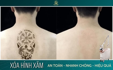 XÓA HÌNH XĂM VĨNH VIỄN KHÔNG ĐỂ LẠI SẸO BẰNG CÔNG NGHỆ LASER HELIOS III