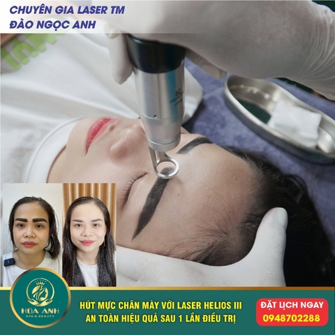 CHÂN MÀY BỊ TRỔ XANH TRỔ ĐỎ CÓ LÀM LẠI ĐƯỢC KHÔNG ? LASER HÚT HẾT SẠCH MÀU CHÂN MÀY CŨ