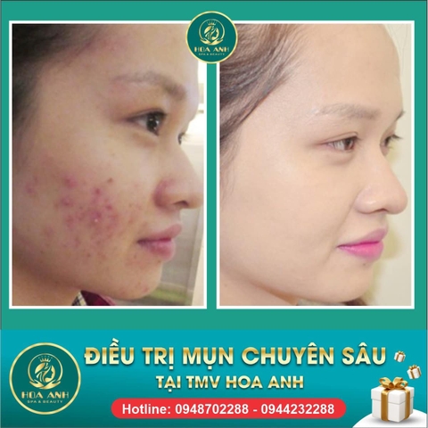 ĐIỀU TRỊ MỤN CHUẨN Y KHOA  - ƯU ĐÃI TRỌN GÓI CHỈ CÒN 499K