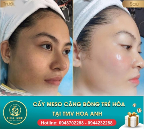 TIÊM MESO CĂNG BÓNG DA LÀ GÌ ? ĐƯỢC BAO LÂU ? GIÁ BAO NHIÊU TIỀN ?