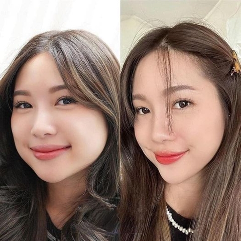 TIÊM BOTOX GỌN HÀM BAO NHIÊU CC ? LƯU Ý SAU KHI TIÊM BOTOX THON GỌN HÀM