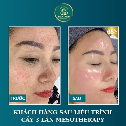 TIÊM MESO CĂNG BÓNG DA LÀ GÌ ? TIÊM MESO CĂNG BÓNG DA DUY TRÌ ĐƯỢC BAO LÂU ?