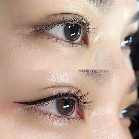 PHUN MÍ MỞ TRÒNG LÀ GÌ ? PHUN MÍ MỞ TRÒNG CÓ BỊ ĐAU KHÔNG ? BẢNG GIÁ PHUN MÍ MẮT