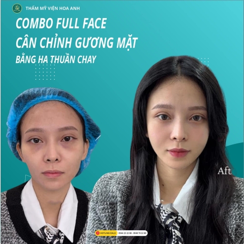 TIÊM FILLER MÁ BABY LÀ GÌ ? TIÊM FILLER MÁ BABY CÓ ẢNH HƯỞNG GÌ KHÔNG ?