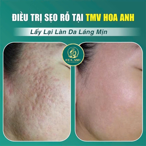 ĐIỀU TRỊ SẸO RỖ BẰNG LASER BAO LÂU THÌ HẾT ? CÁCH CHĂM SÓC DA SAU KHI LASER