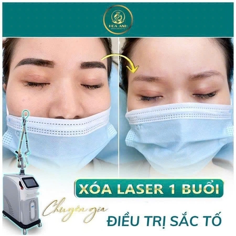 XÓA CHÂN MÀY ĐÃ LÀM BỊ HỎNG BẰNG LASER ? CÁCH CHĂM SÓC DA SAU KHI XÓA CHÂN MÀY