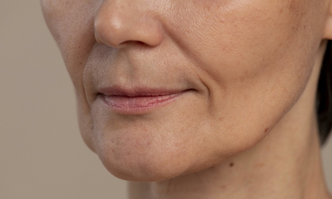 TIÊM FILLER RÃNH CƯỜI LÀ GÌ ? DUY TRÌ TRONG BAO LÂU ?