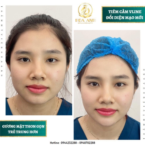 TIÊM BOTOX THON GỌN HÀM LÀ GÌ ? TIÊM BOTOX THON GỌN HÀM GIỮ ĐƯỢC BAO LÂU