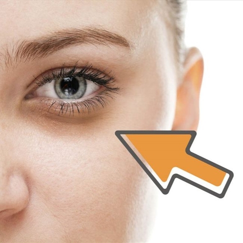 CẤY MESO TRỊ QUẦNG THÂM MẮT - GIẢI QUYẾT NỔI DA '' CÚ ĐÊM ''