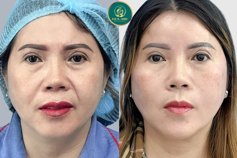 KHÓA HỌC CĂNG CHỈ DA MẶT – BÍ QUYẾT TRẺ HÓA DA KHÔNG PHẪU THUẬT