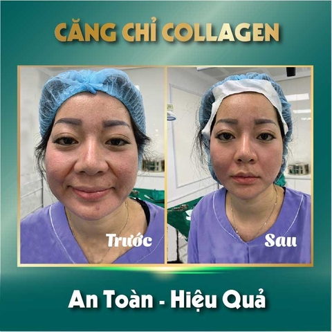 CĂNG CHỈ COLLAGEN LÀ GÌ ? NHỮNG ĐIỀU CẦN BIẾT VỀ CĂNG CHỈ COLAGEN