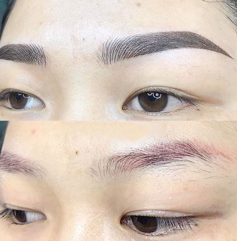 CHÂN MÀY BỊ TRỔ XANH TRỔ ĐỎ PHẢI LÀM THẾ NÀO ? LASER XÓA CHÂN MÀY BỊ TRỔ XANH, TRỔ ĐỎ