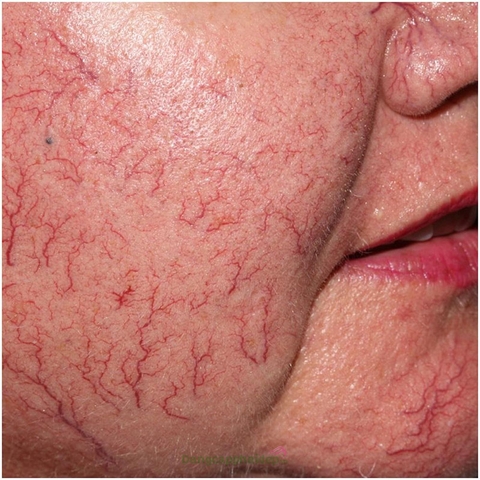 KHÓA HỌC ĐIỀU TRỊ ĐỎ DA – MAO MẠCH ĐỎ CHUYÊN SÂU TẠI THẨM MỸ VIỆN HOA ANH