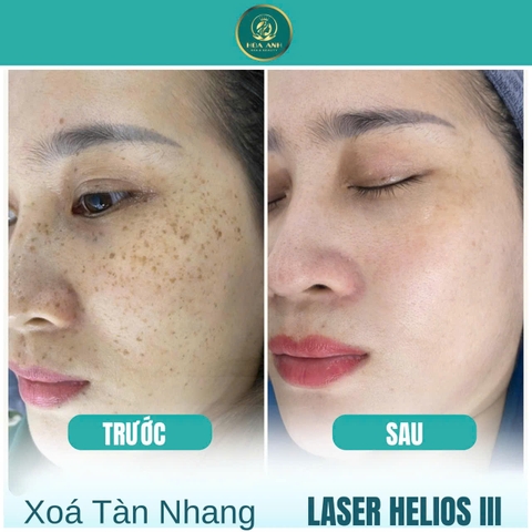 ĐIỀU TRỊ TÀN NHANG BẰNG CÔNG NGHỆ LASER