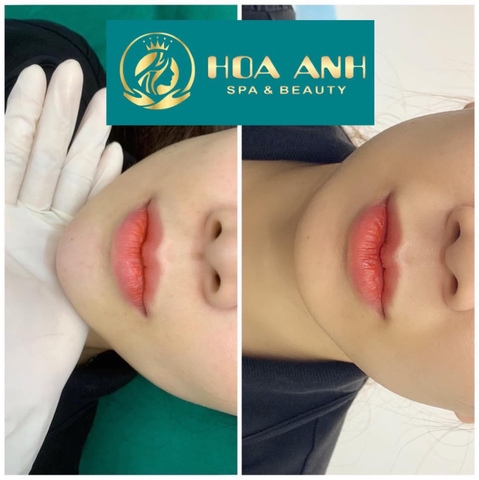 TIÊM FILLER CẦM LÀ GÌ ? TIÊM FILLER CẦM BAO NHIÊU CC LÀ ĐẸP