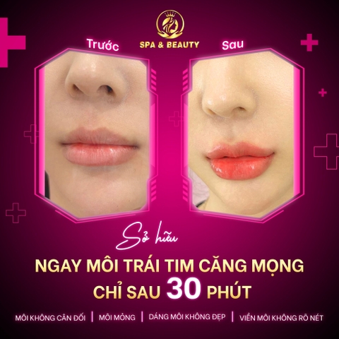 TIÊM FILLER MÔI LÀ GÌ TIÊM FILLER MÔI CÓ AN TOÀN KHÔNG