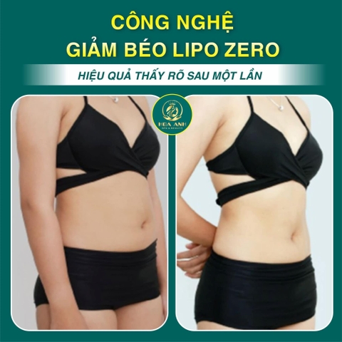 H1: Khóa Học Giảm Béo Bằng Công Nghệ Lipo Zero - Giải Pháp Đột Phá Trong Thẩm Mỹ