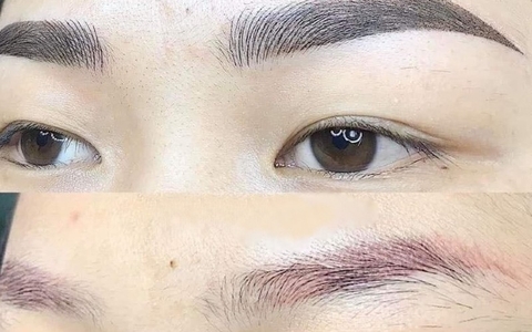 LASER XÓA XĂM CHÂN MÀY CÓ HIỆU QUẢ KHÔNG ? CÁCH CHĂM SÓC DA SAU KHI XÓA XĂM CHÂN MÀY