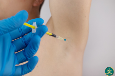 KHÓA HỌC CẤY BOTOX GIẢM MỒ HÔI VÙNG NÁCH & CHÂN – THẨM MỸ VIỆN HOA ANH