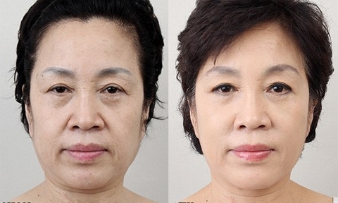 NÂNG CƠ HIFU LÀ GÌ ? NÂNG CƠ HIFU CÓ HIỆU QUẢ KHÔNG ? HIỆU QUẢ ĐƯỢC BAO LÂU