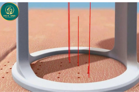 KHÓA HỌC ỨNG DỤNG CÔNG NGHỆ CO2 FRACTIONAL TRONG THẨM MỸ LÀM ĐẸP