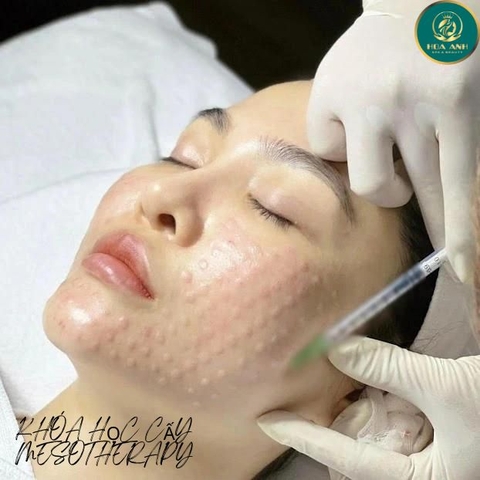 Khóa Học Cấy Meso